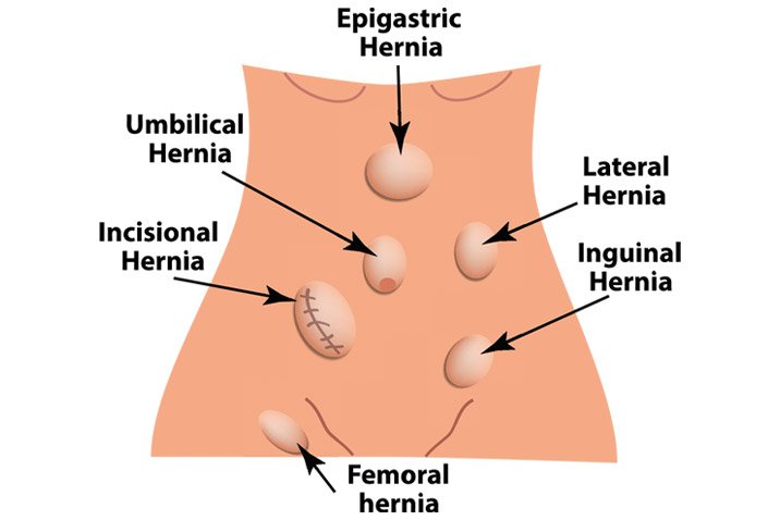 Best Hernia Repair Treatment In  New Delhi